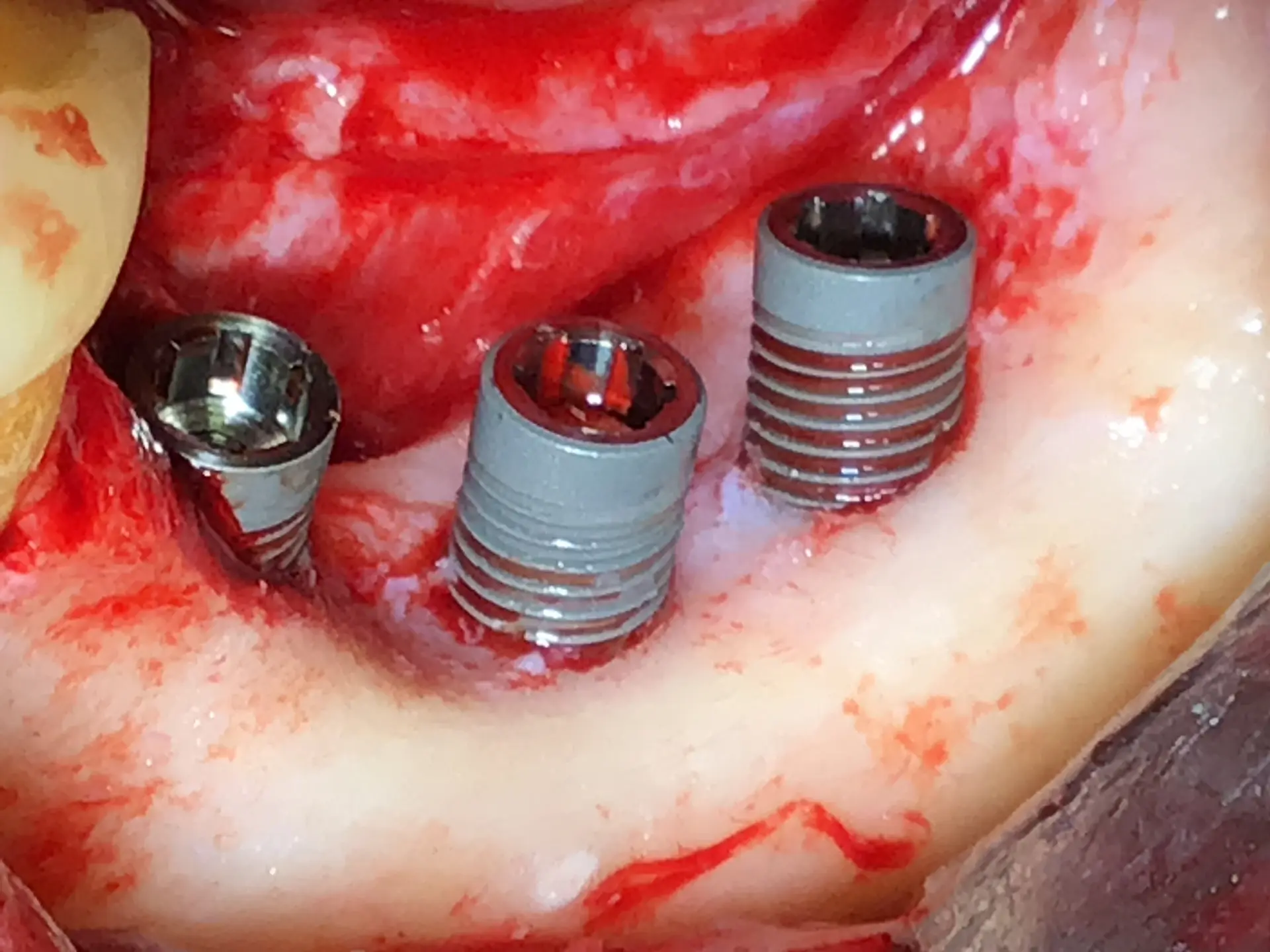 3. Platzierung der Implantate in idealer Position