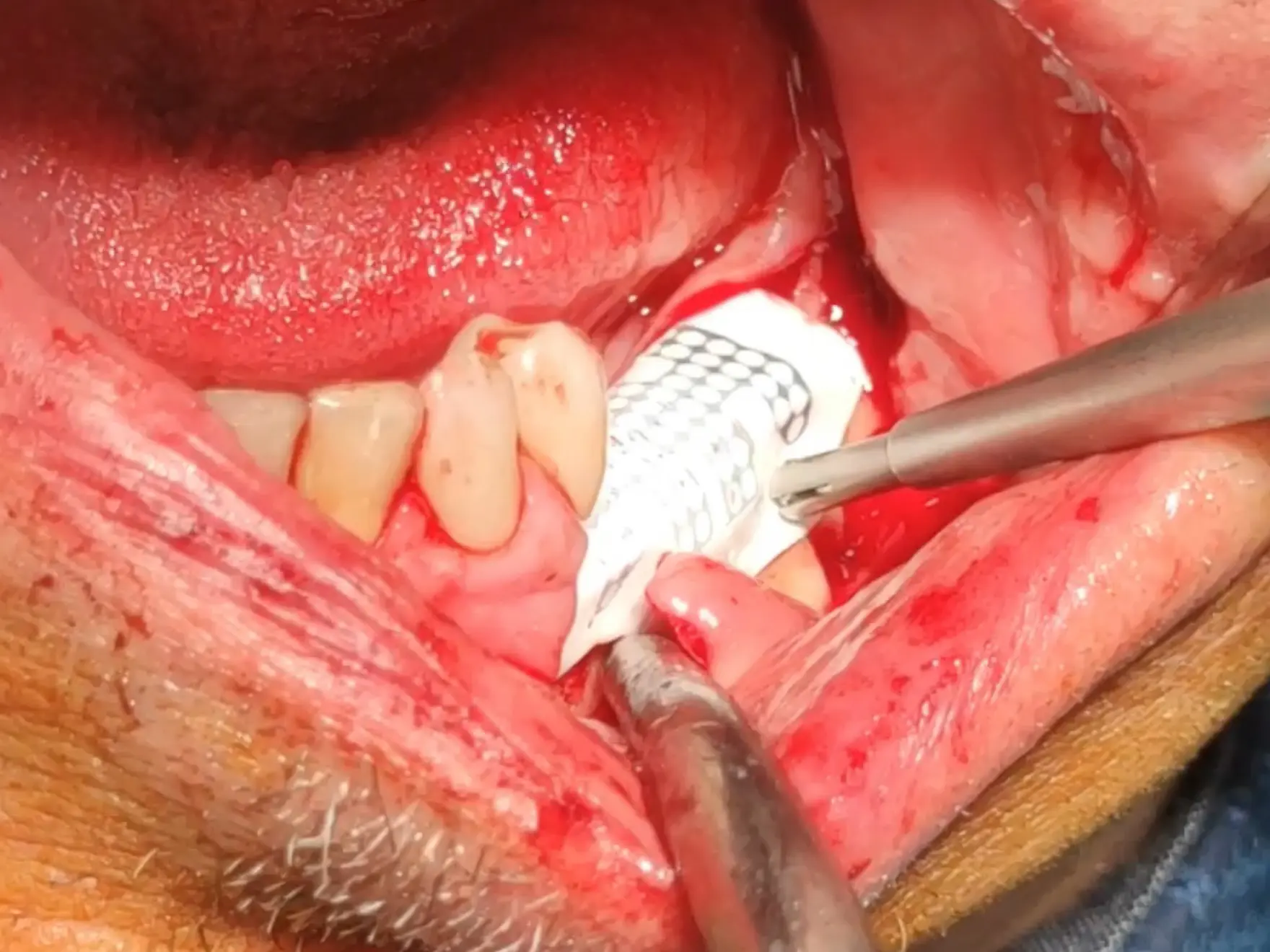 4. Knochen-Rekonstruktion mit Membranverfahren