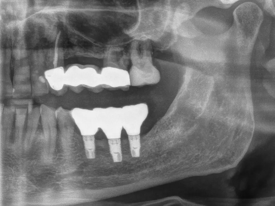 4. Prothetische Versorgung der Implantate durch Hauszahnarzt durch Kronen
