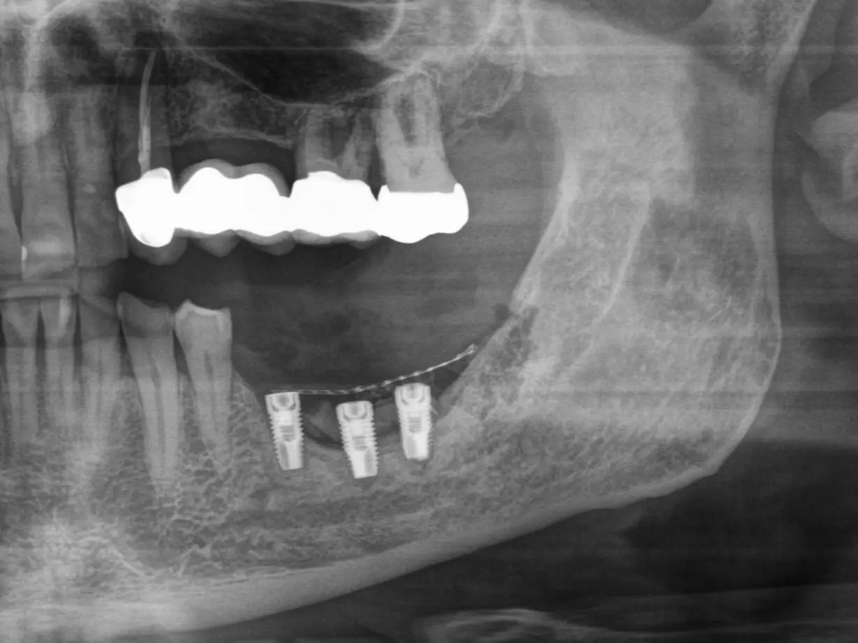 5. Röntgenkontrolle nach Implantation und Knochenaufbau