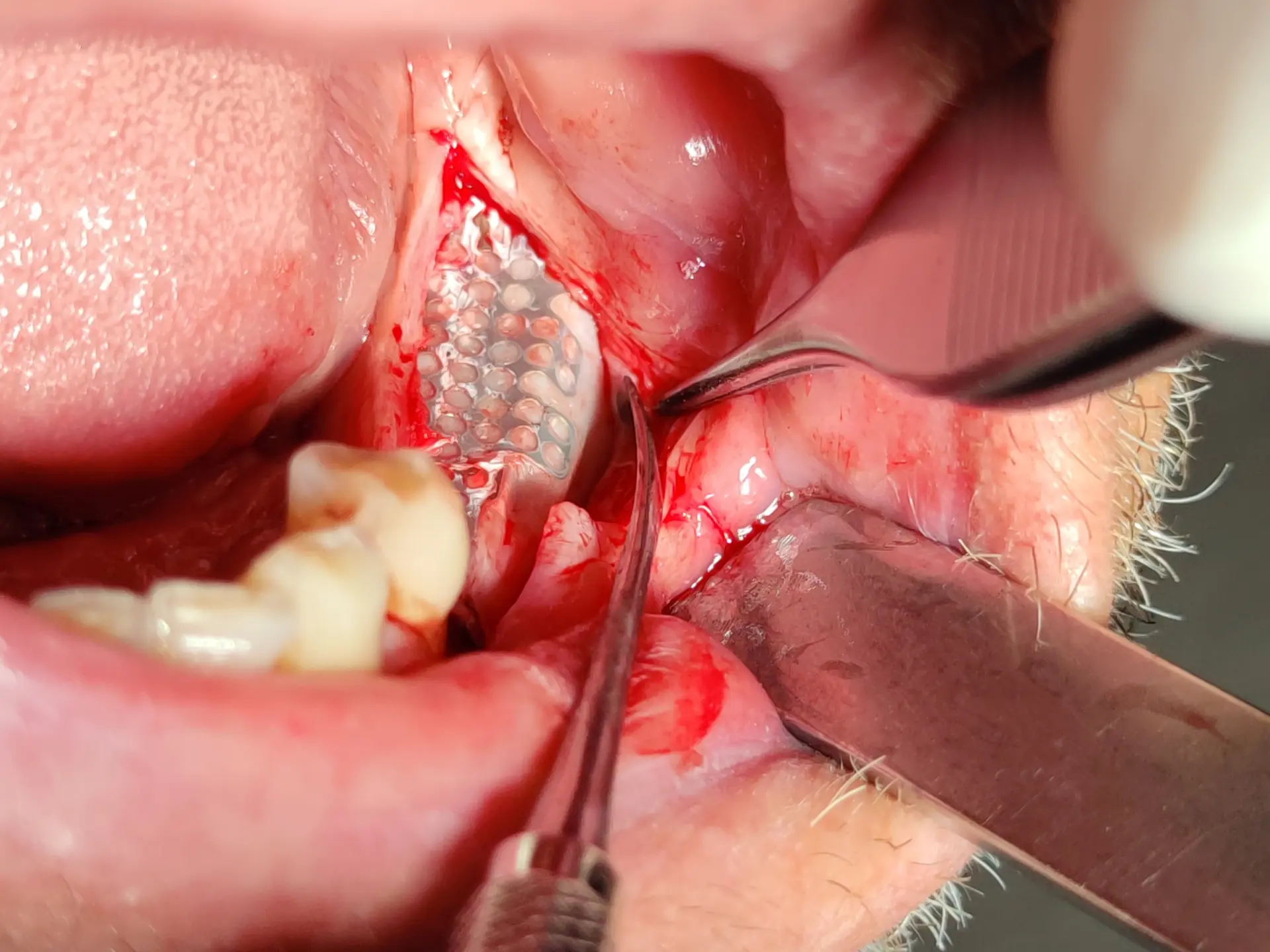 6. Freilegung der Implantate und Entfernung der Membran