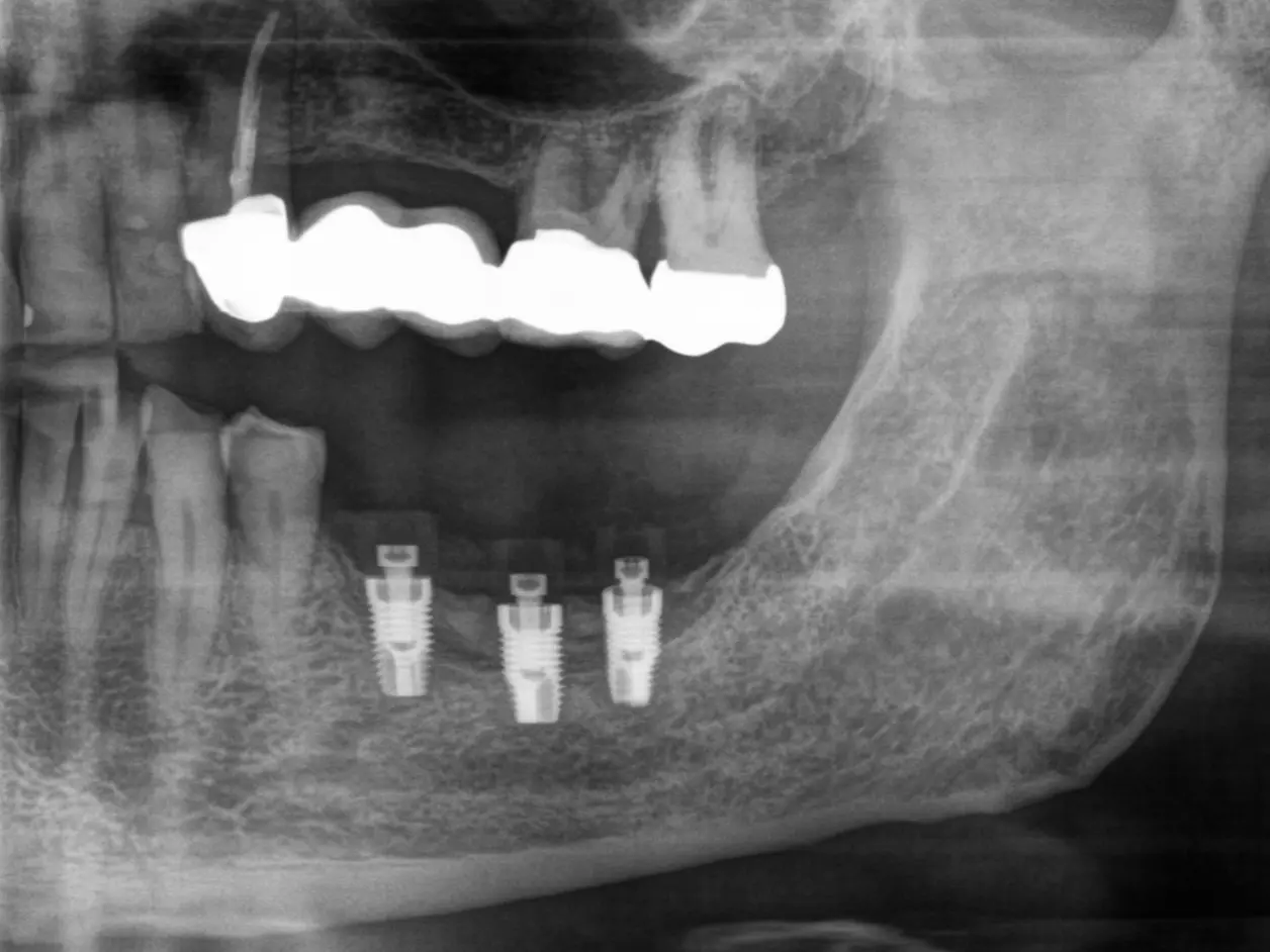 Bild 9 mit Röntgenkontrolleder Implantate nach 7 Monaten Einheilzeit