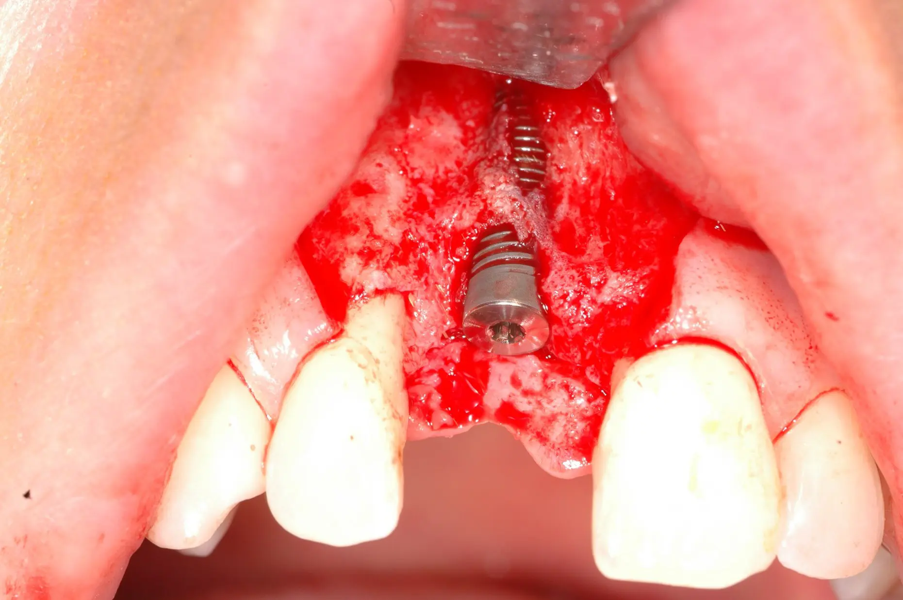 Klinisches Fallbeispiel - 2. Implantation mit Knochendefekt