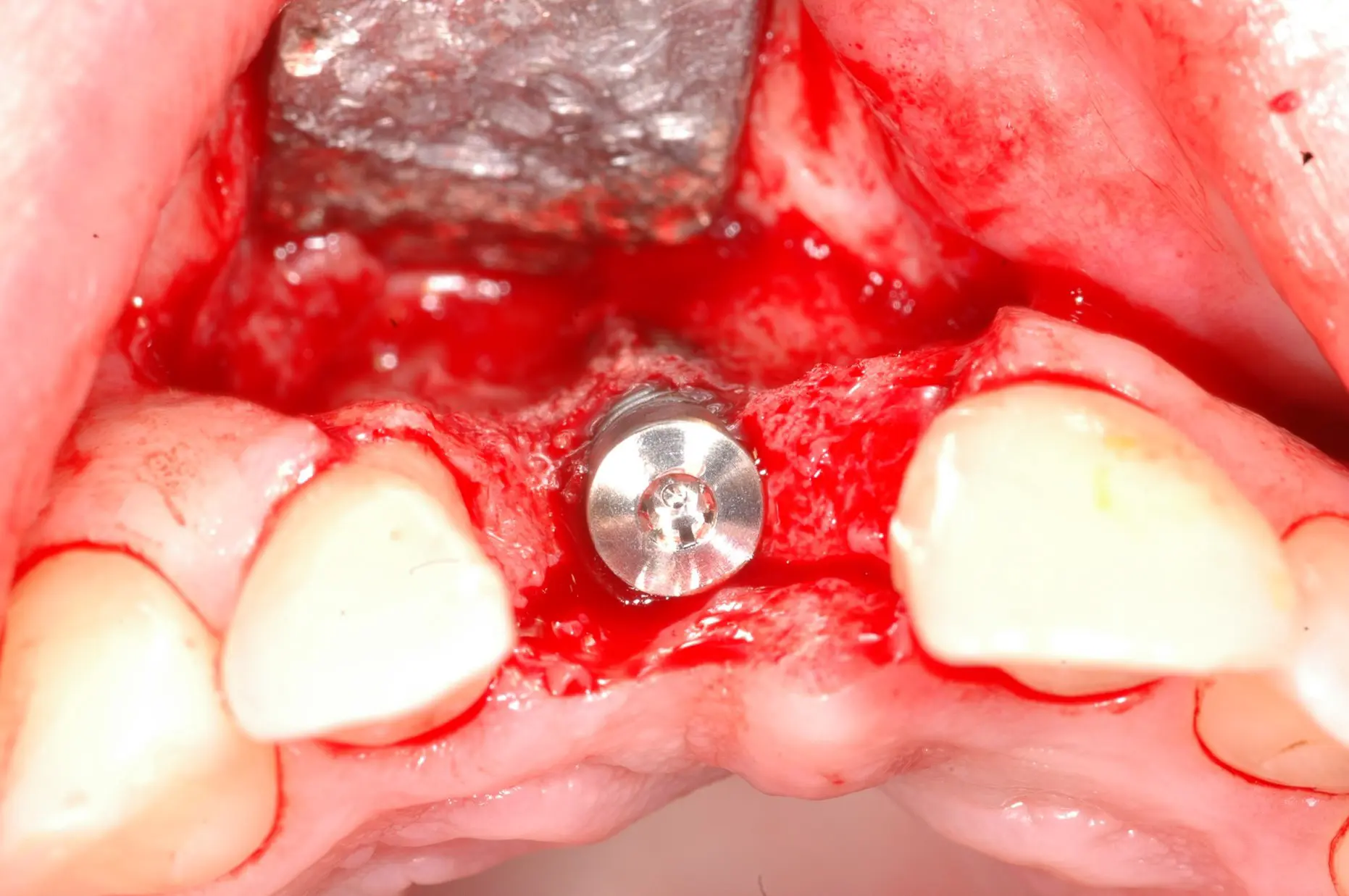 Klinisches Fallbeispiel - 3. fehlende Knochenwand buccal