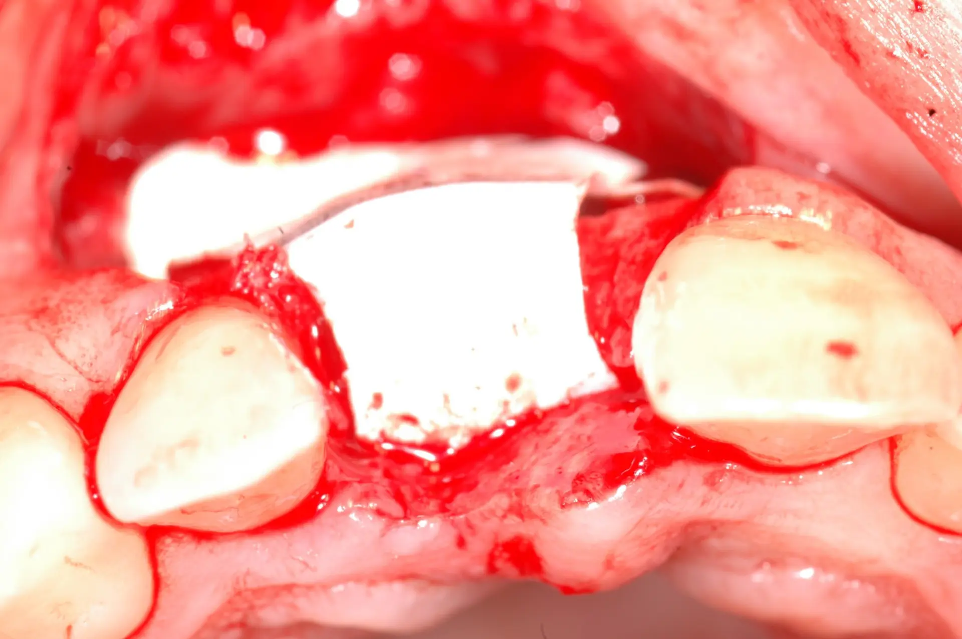 Klinisches Fallbeispiel - 4. Gesteuerte Knochenregeneration mit PTFE Membran