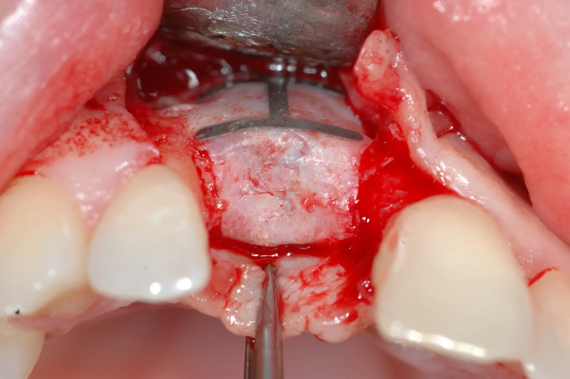 Klinisches Fallbeispiel - 7. körpereigenes Knochenregenerat unter PTFE Membran